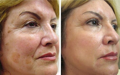 Anna from Wroclaw got a noticeable effect in smoothing wrinkles and strengthening the contour of the face after using Canabilab