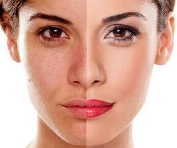 facial skin changes after laser skin