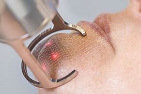 fractional technology of laser rejuvenation