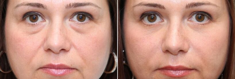Before and after blepharoplasty - removal of the fat body under the eyes and tightening of the skin