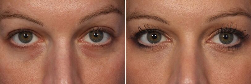 Before and after the use of injectable fillers - reduction of under-eye circles
